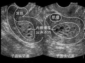 子宫内膜薄 是有原因的...