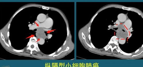 小细胞肺癌是怎么发生的