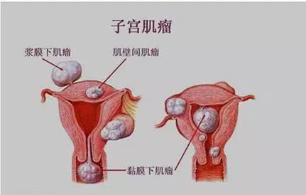 子宫肌瘤多大需要做手术治疗