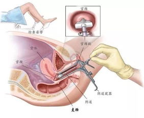 半年前TCT正常，半年后会不会病变？