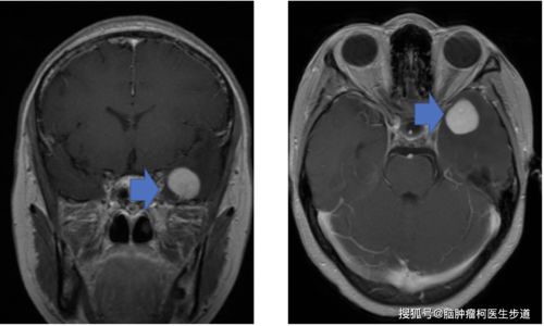 与脑膜瘤长得相似的几种脑肿瘤,有的有恶性倾向