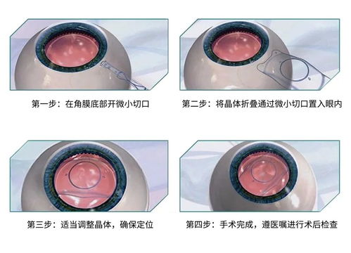 一只眼睛内斜视自我矫正训练