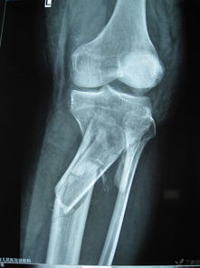 刚刚做的胫腓骨骨折手术 米粒分享网 Mi6fx Com