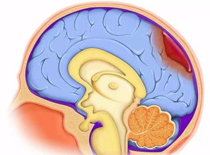 警惕 最近身体有这几个症状,脑出血快发生了,万不能大意