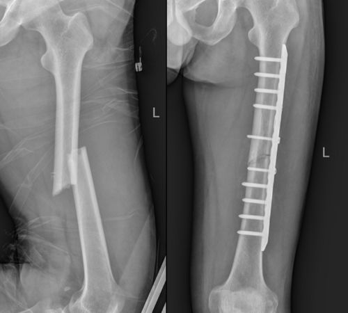 会昌县人民医院骨科运用逆行股骨髓内钉技术为患者实施微创手术