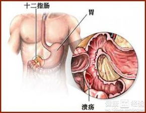 浅表性胃炎什么食物不能吃