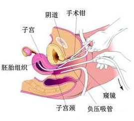 人流5天后开始流血是什么原因