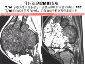 骨巨细胞瘤影像诊断及鉴别诊断 影像天地