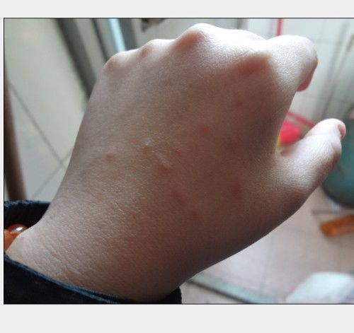 求解 这是什么 不是蚊子咬的 不痒 碰到还会疼 12月26日被狗咬了一口 出血了 现在疫苗接种了2次 