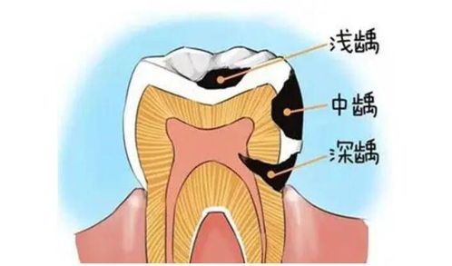 龋齿有哪些典型症状