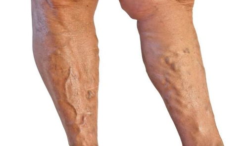 什么是 蚯蚓腿 静脉曲张的4大诱因,早了解早预防