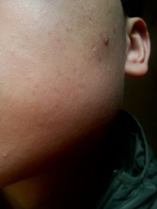 脸上长这样的痘痘,像是皮肤下面的小红点,麻烦帮忙看看怎么回事,该怎么治疗 春天好干燥 