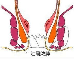 肛周脓肿是什么,又该如何去防治 