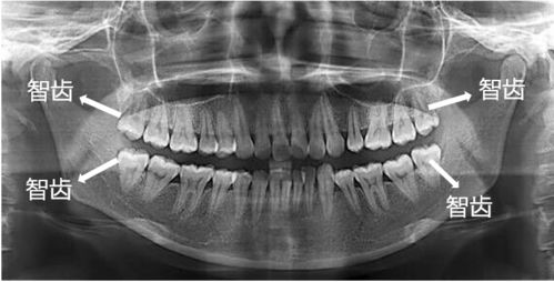 拔智齿能瘦脸,会变美 协和专家说,无论美不美,这些情况该拔就拔 中国医疗 