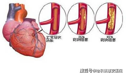 心肌缺血 