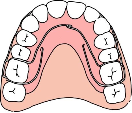 中家医家庭医生口腔做矫正牙齿掉了是怎么回事呢