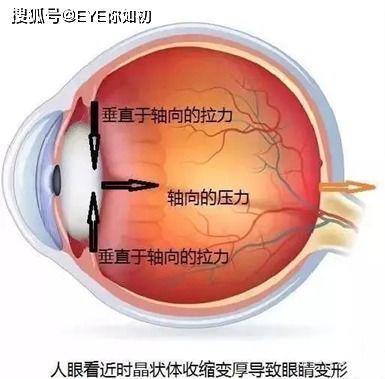 眼轴是什么 为什么说眼轴长度和近视有关