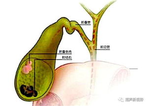 胆囊息肉的形成与什么有关