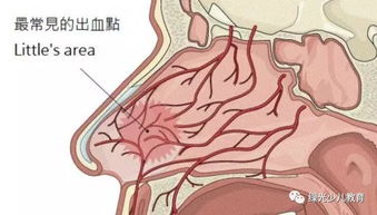 错误 孩子流鼻血别再让他仰头止血了 