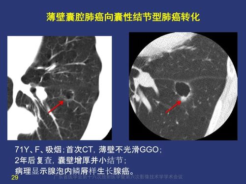 囊腔性肺癌如何诊断 空洞性肺癌