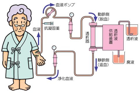 维护血透通路,捍卫肾衰患者生命线