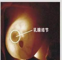 乳房结节 三年之间竟成乳腺癌