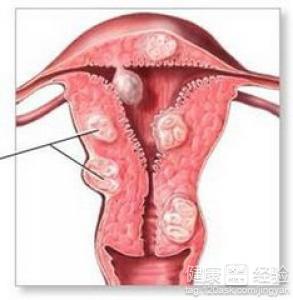 子宫肌瘤形成原因分别是什么呢