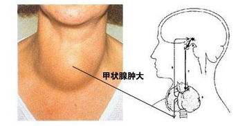 首大赵桂丽 为什么甲状腺越来越容易出毛病 一