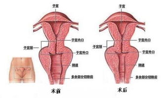 阴道缩紧手术手术前要注意什么