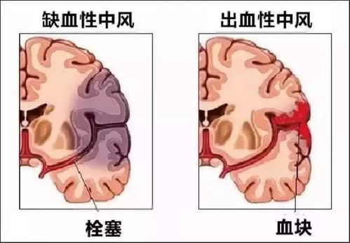 46岁阿姨脑梗瘫痪,医生告诫 厨房1种调料是祸害,不少人还在吃