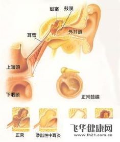 得了中耳炎需要做CT吗