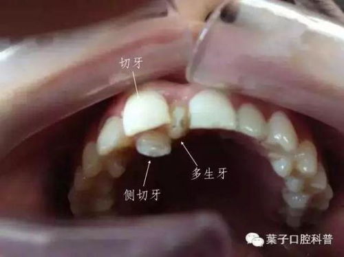 牙齿间隙变大怎么办 孩子有多生的牙齿,需要拔掉吗 叶子口腔科普