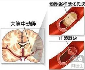 脑梗死还会复发吗 如何预防复发