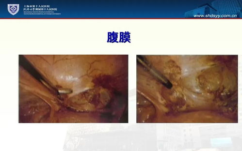 教学PPT 超声引导 巧囊巧治