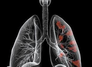 肺纤维化 肺癌 