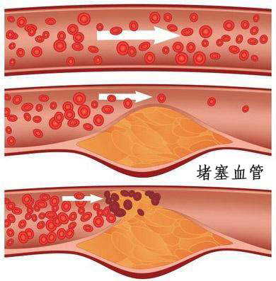 高血压跟血管堵塞的关系,看完你就懂了