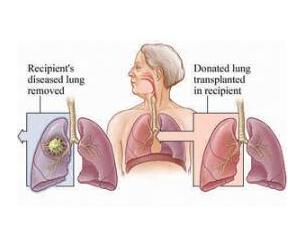 肺能移植吗