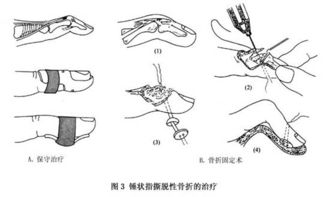 手部伸肌腱损伤治疗方法 如何治疗手部伸肌腱损伤