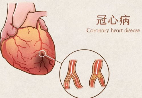 这5种胸痛不是心肌缺血 心肌缺血引起的胸痛而是这样的疼