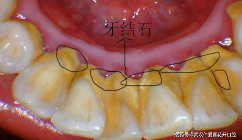 用手抠掉牙结石 医生劝你住手,用绝佳方法清除难道不香吗