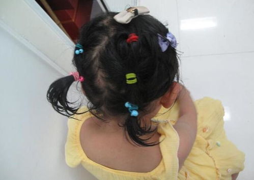 3岁女孩突然大量掉头发,送医后妈妈怒扇自己耳光 