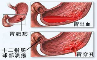 胃出血是怎么回事呢(胃出血是什么问题)