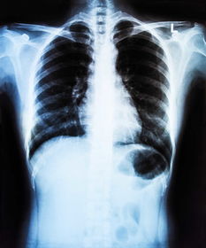 肺癌早期有三处痛，具体都指的是什么