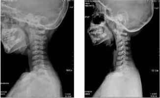 颈椎病已成低龄化趋势,儿童也成颈椎病 重灾区 ,负面影响更为深远