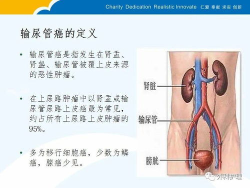 输尿管癌的护理查房