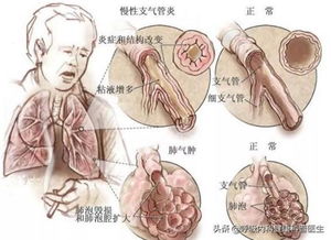 慢性支气管炎的治疗方法有哪些？如何预防慢性支气管炎的发生？