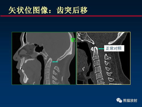 颅底重要CT解剖及其临床意义 