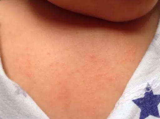 这种疹子出生都会长且不用治 99 广州妈妈误以为湿疹