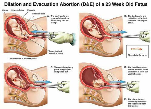 恐怖 堕胎不超度被其缠身竟有如此严重的后果