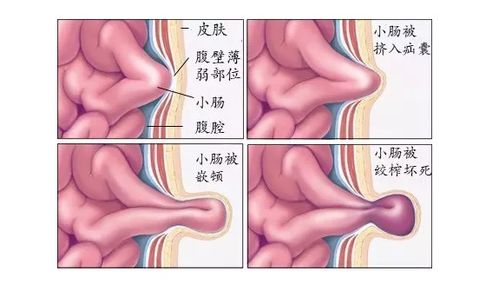 医者解读 关于腹股沟疝你知道多少